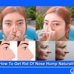 How To Get Rid Of Nose Hump Naturally