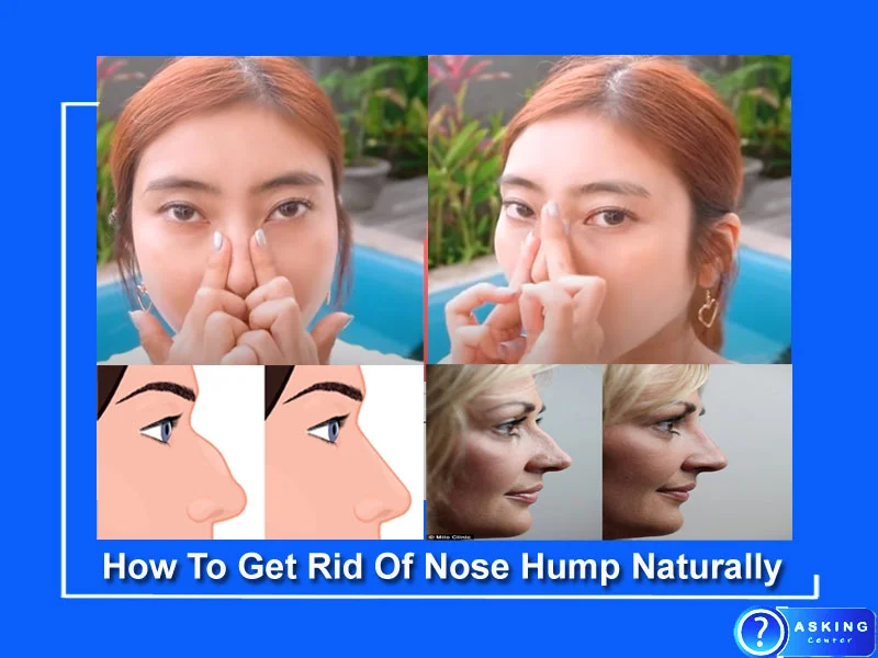 How To Get Rid Of Nose Hump Naturally